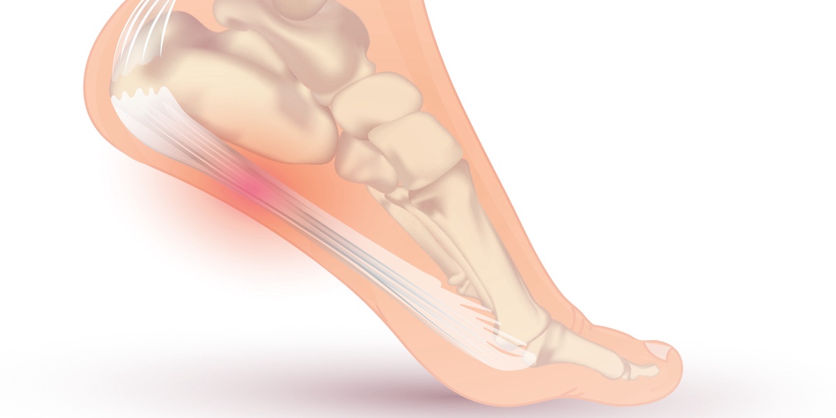 Plantar Fasciitis service photo